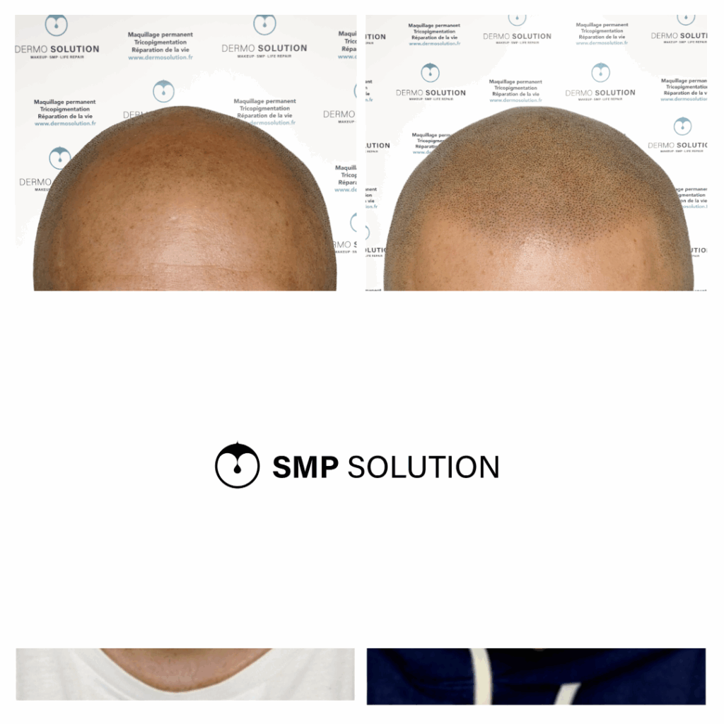 Micropigmentation capillaire – avant après de face Cuir chevelu vu de face avant et après une micropigmentation capillaire