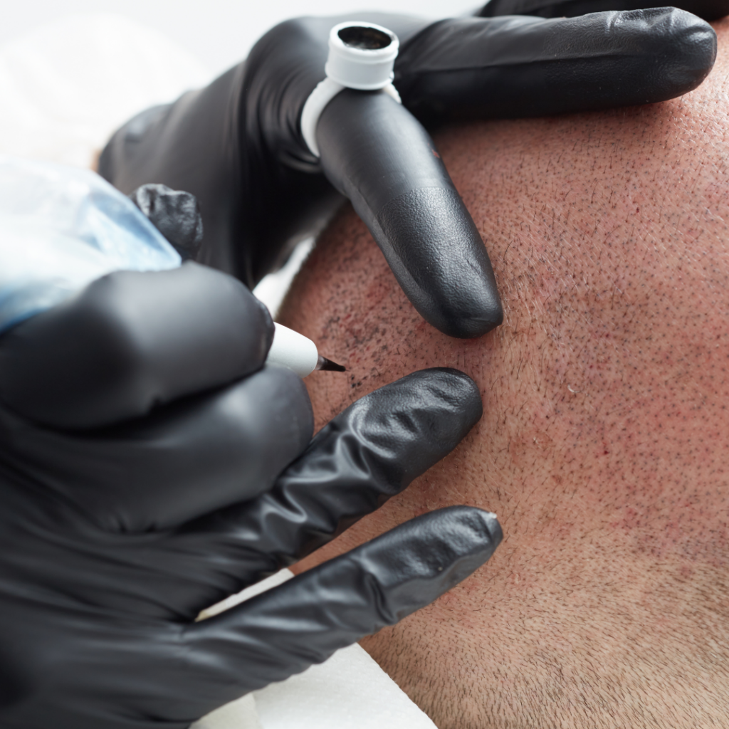 Main gantée réalisant une tricopigmentation sur un cuir chevelu