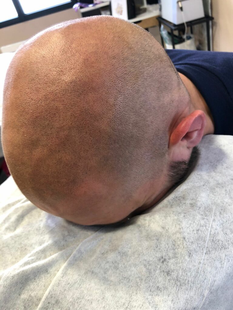 Effet rasé SMP Solution